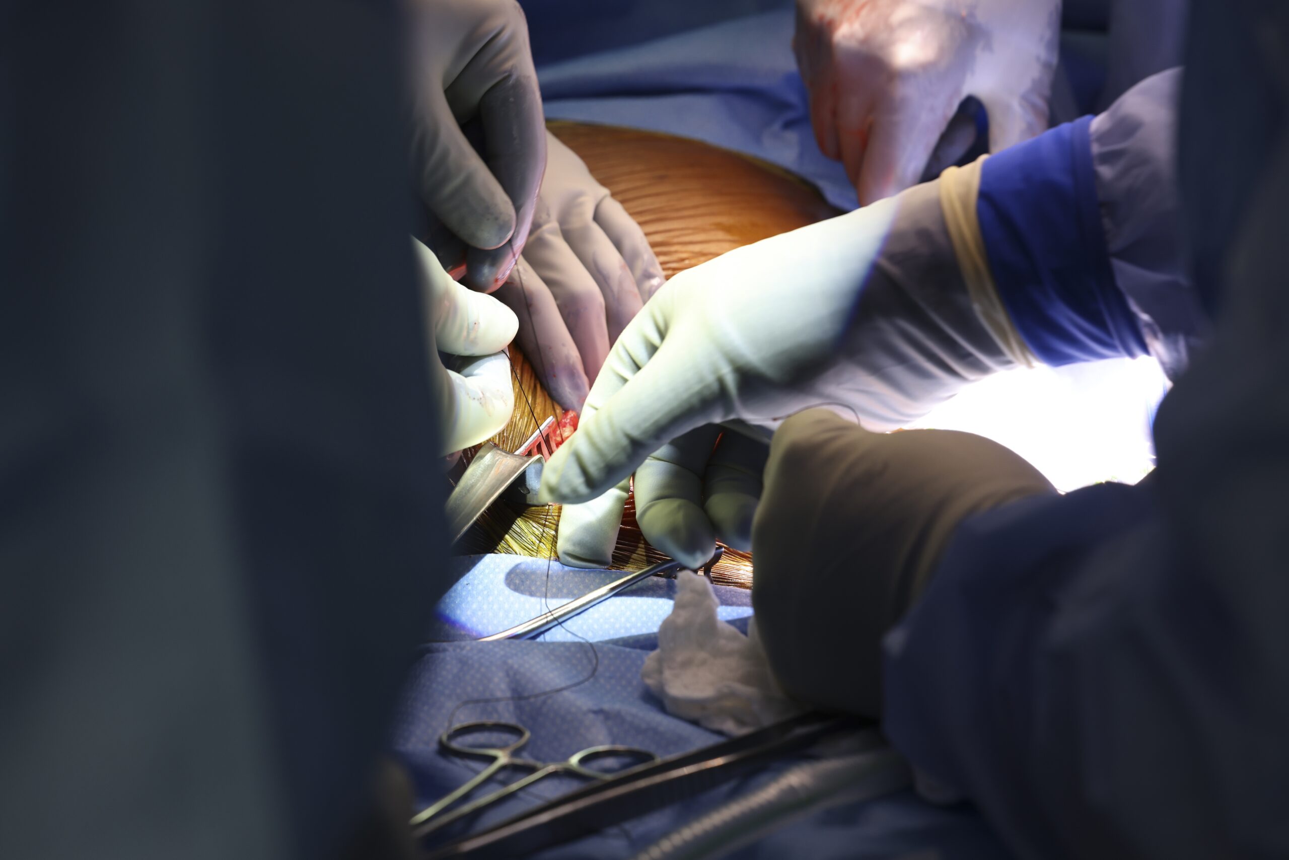 Negli Stati Uniti, il primo xenotrapianto di rene su un paziente vivo