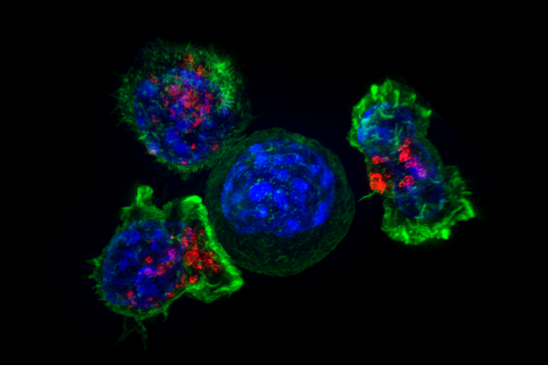 Nuovi linfociti T ingegnerizzati contro la leucemia mieloide acuta