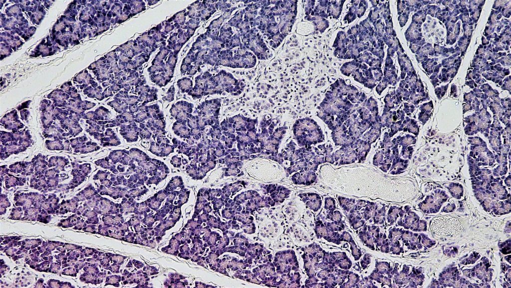 tumore del pancreas