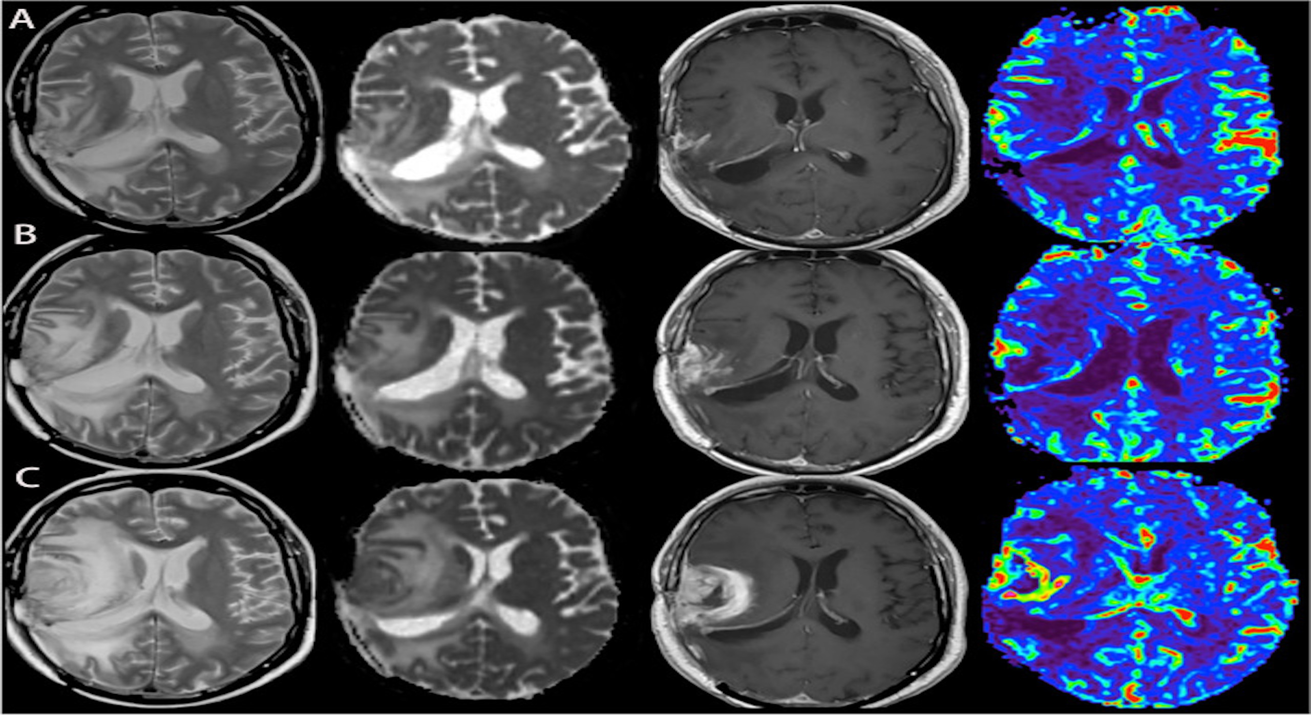 Immunoterapia genica contro il glioblastoma multiforme