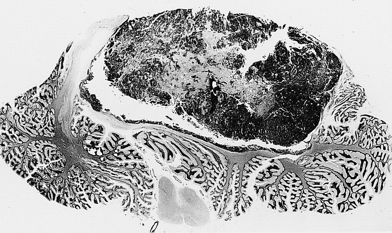 Identificati nuovi meccanismi all’origine del medulloblastoma